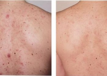 حبوب الظهر وعلاجها