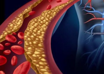 علامات ارتفاع الكوليسترول الضار في الدم