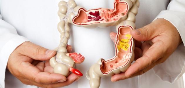 نصائح هامة لمرضى القولون العصبي