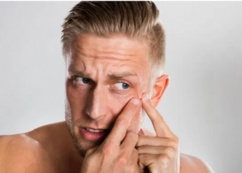 أسباب حبوب الوجه بعد الثلاثين