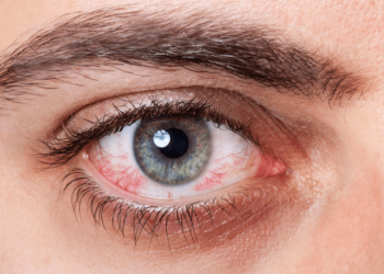 طرق علاج احمرار العين