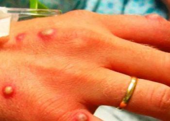 وزارة الصحة التركية تعلن دخول “جدري القرود” إلى أراضيها