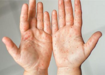 رصدُ أوّل إصابة بفيروس جدري القرود في السعودية