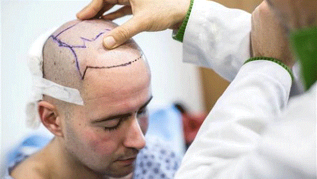 تركيا استقبلت مليون أجنبي في 2022 من أجل زراعة الشعر