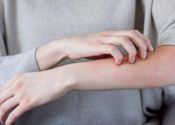 ارتفاع حالات الجرب في تركيا