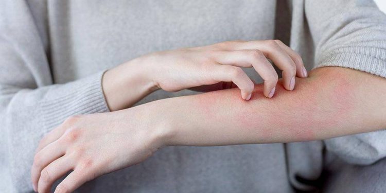 ارتفاع حالات الجرب في تركيا