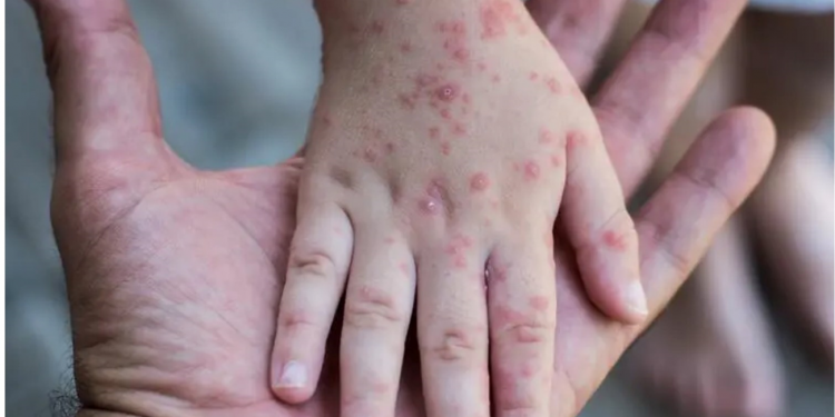 الصحة التركية تعلن عدم رصد أي إصابة بجدري القردة