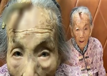 مسنة صينية ينبت لها “قرن” في جبهتها!