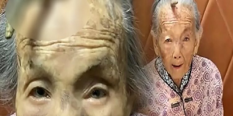 مسنة صينية ينبت لها “قرن” في جبهتها!